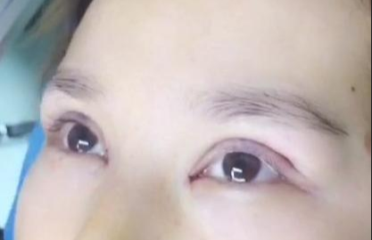 埋線雙眼皮有哪些注意事項(xiàng)？