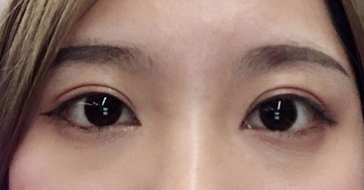 埋線雙眼皮幾天可以碰水？