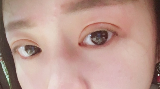 埋線雙眼皮可以保持幾年？埋線雙眼皮的危害有哪些？