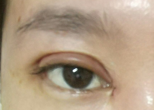埋線雙眼皮可以維持幾年？