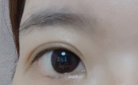 雙眼皮埋線大概多久恢復？