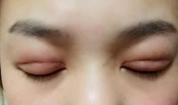 埋線雙眼皮幾天能消腫？