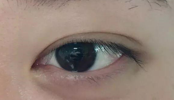 埋線雙眼皮有沒有危害？