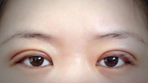 定點(diǎn)雙眼皮幾天能恢復(fù)好？定點(diǎn)做雙眼皮多少錢？