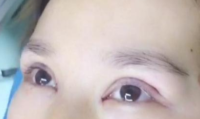 定點雙眼皮手術(shù)效果自然嗎？