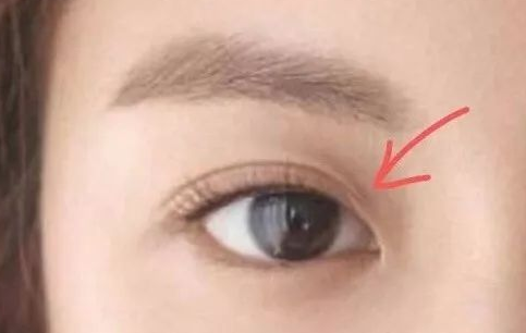 定點雙眼皮一般多少錢？
