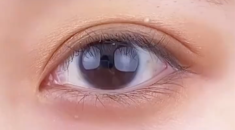 定點(diǎn)雙眼皮多少錢？