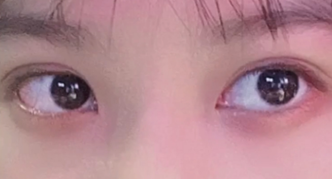 雙眼皮定點能維持多久？