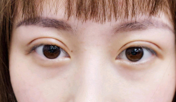 定點雙眼皮是什么意思？