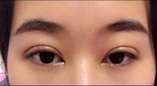 單眼皮割雙眼皮風險大嗎？