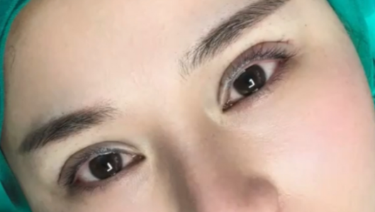 40歲做埋線雙眼皮的效果好不好？