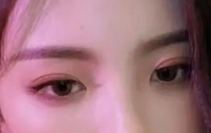 割雙眼皮會有疤痕嗎？割雙眼皮幾個月定型？