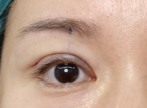 割雙眼皮后有危害嗎？