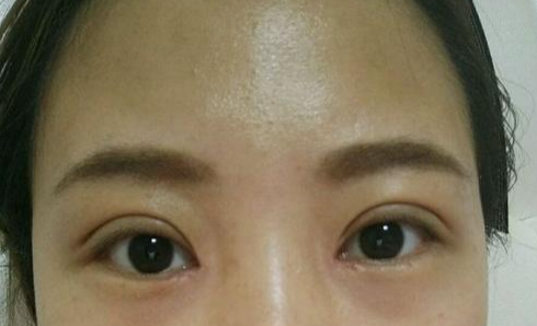 定點(diǎn)雙眼皮會腫嗎？定點(diǎn)雙眼皮會有疤痕嗎？
