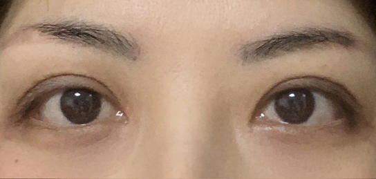 定點(diǎn)雙眼皮會(huì)腫嗎？