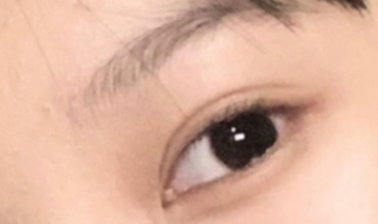 割雙眼皮恢復(fù)需要多久？
