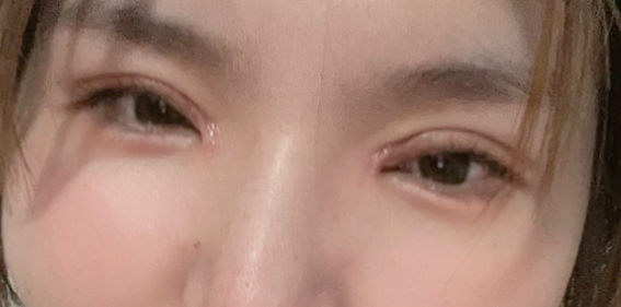 割雙眼皮后要冰敷多久？
