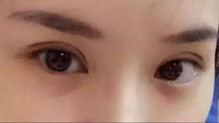 做雙眼皮對身體有沒有危害？