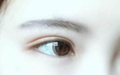 開眼角的恢復期要多長？