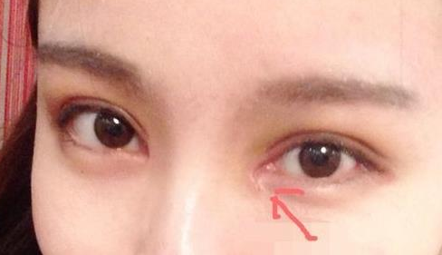 單眼皮開內(nèi)眼角會留疤嗎？