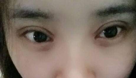 開眼角疼嗎？