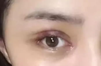 韓式開眼角失敗了怎么辦？