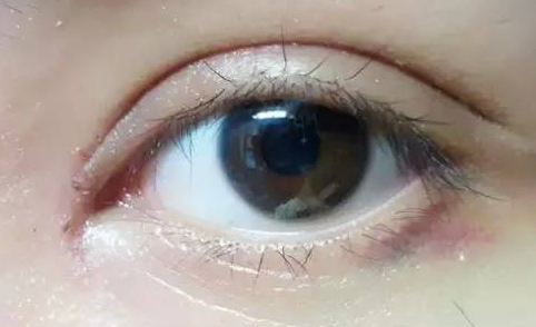 韓式開眼角好嗎？韓式開眼角術(shù)后怎么護(hù)理？
