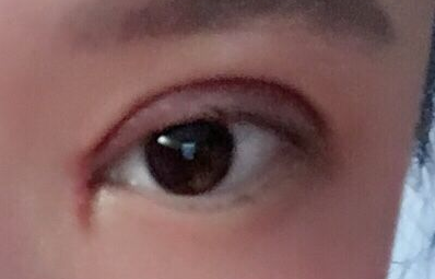 韓式開眼角手術有哪些優(yōu)勢？