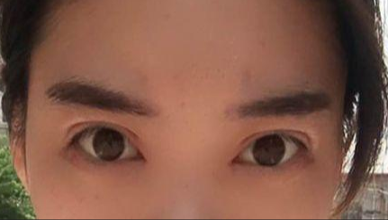 韓式開(kāi)眼角的有副作用嗎？