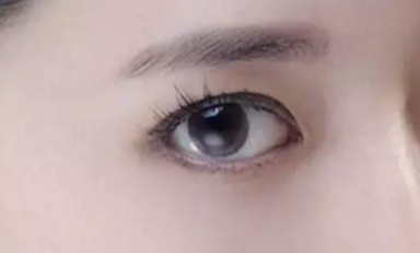 韓式開眼角的手術(shù)費(fèi)用是多少？