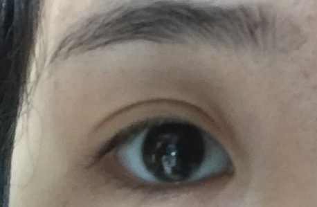 開內(nèi)眼角拆線后變化明顯嗎？開內(nèi)眼角會(huì)不會(huì)留疤？