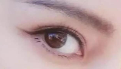開內眼角會讓你眼睛變大嗎？