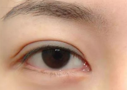 開內(nèi)外眼角多久能恢復(fù)好？開內(nèi)外眼角多少錢？