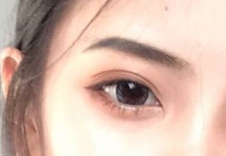 開內(nèi)外眼角的恢復(fù)期是多久？術(shù)后后遺癥有哪些？