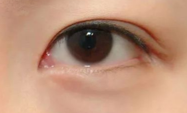 開內(nèi)眼角的優(yōu)缺點有哪些？