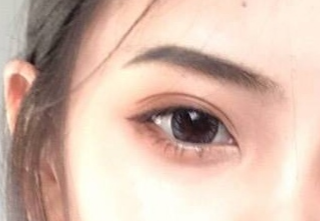 開內(nèi)外眼角有什么壞處？