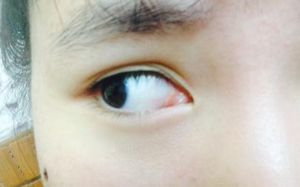 開(kāi)內(nèi)眼角風(fēng)險(xiǎn)有多大？