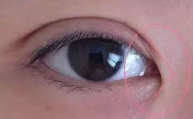 開內(nèi)眼角的作用有哪些？開內(nèi)眼角都會(huì)回縮嗎？