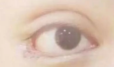 開(kāi)內(nèi)眼角的效果好嗎？