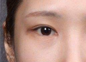 開內(nèi)外眼角腫幾天？
