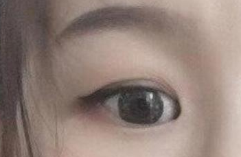 開內(nèi)眼角的手術(shù)費用多少？