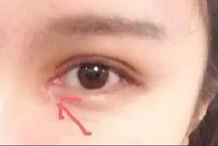 開(kāi)眼角割雙眼皮拆線嗎？