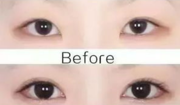 開眼角的危害大嗎？