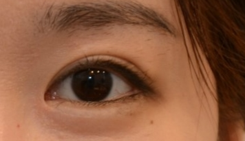 開眼角有效果嗎？開眼角有哪些危害？
