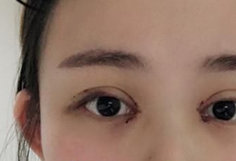 開眼角后多長時間能恢復(fù)？