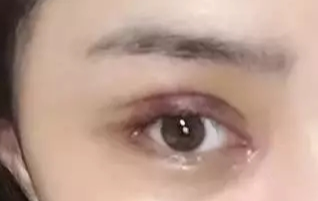 開眼角一般要恢復多久？