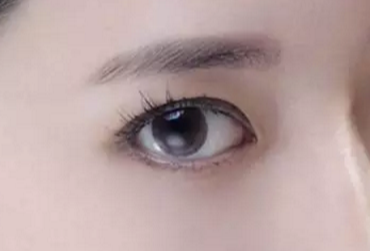 開(kāi)眼角術(shù)后多久才能恢復(fù)？開(kāi)眼角術(shù)后防止疤痕增生怎么做？