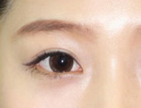 開眼角手術(shù)有哪些適應(yīng)人群呢？開眼角手術(shù)有哪些特點(diǎn)？