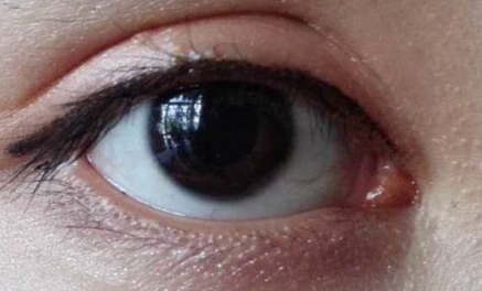 開(kāi)外眼角什么價(jià)格？開(kāi)外眼角什么時(shí)候能好？