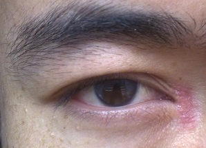 開眼角術(shù)后如何快速消腫？